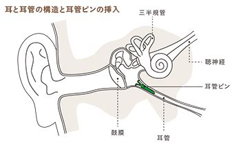 世界初の難治性耳管開放症治療機器 「耳管ピン」を開発。手術が保険適用へ - 東北大学病院