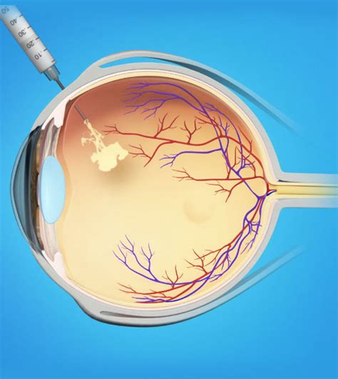 Injection Services New York | Manhattan Retina and Eye