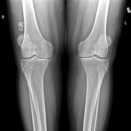 Secondary synovial osteochondromatosis | Radiology Case | Radiopaedia.org