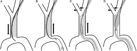 llustrations  combined endovascular antegrade  direct retrograde