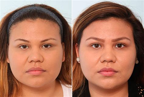 Buccal Fat Everything You Should Know About This Procedure