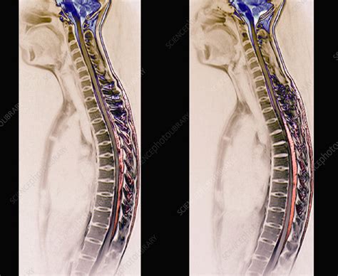 Healthy Spine Mri Scans Stock Image C Science Photo Library