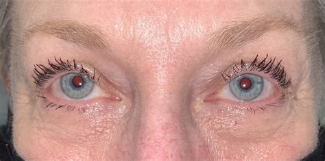 5 Upper Eyelid Surgery Before And After Photos Dallas Plano Texas Cosmetic Reconstructive