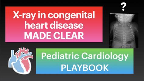 X Ray In Congenital Heart Disease Made Clear By Pediatric Cardiology