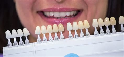 Teeth Bonding vs Veneers | What is best for me?