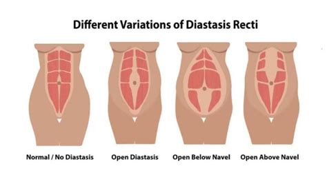 Latihan Untuk Mengencangkan Otot Perut Pada Diastasis Recti