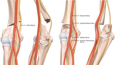 View Of The Open Approach To A Supracondylar Humerus Fracture Journal