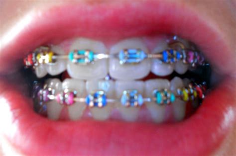 √ Cute Braces Color Combinations