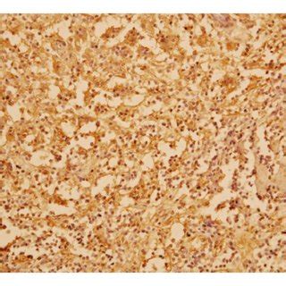 Photomicrograph Of Immunohistochemistry Of The Lesion Showing Positive