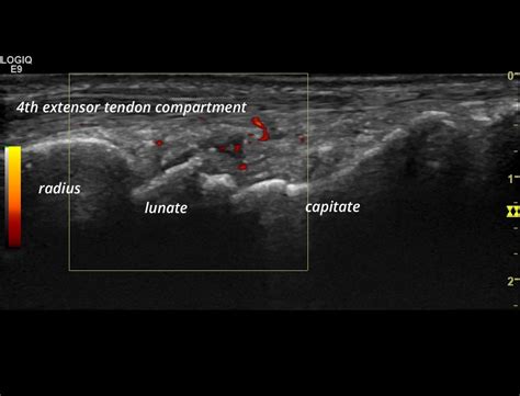 Ra Synovitis Of The Wrist Sonotool®