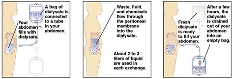 Peritoneal Dialysis Renal Replacement Therapies Libguides At Health Science Information