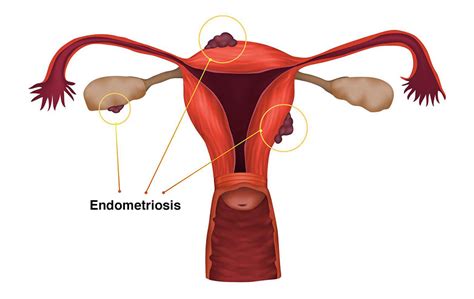 Endometriosis Healthdirect