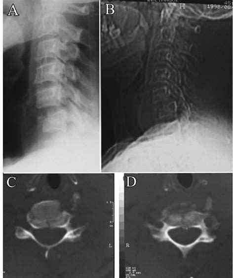 A And B The Preoperative Plain Lateral Radiograph Cervical Spine Download Scientific Diagram