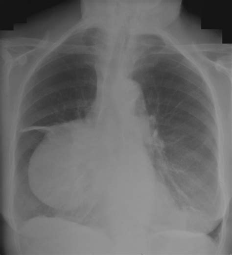 Chest X Ray Pa View Showing A Large Mediastinal Mass Occupying Middle Download Scientific