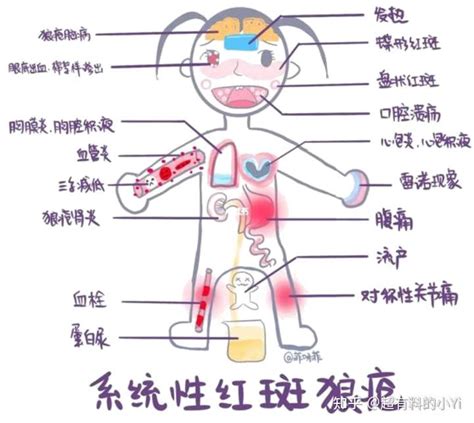 赛琳娜罹患红斑狼疮到底是什么病？ 知乎