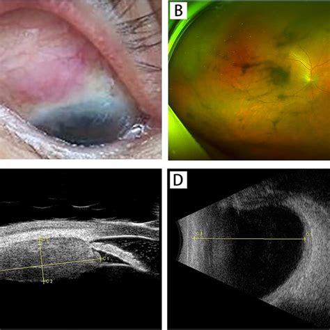 Multimodal Imaging Of The Right Eye Pre Treatment A Edema And Vascular