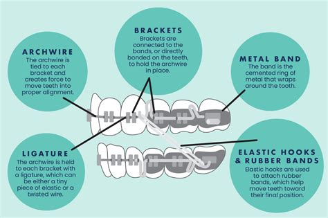 Explaining The Different Parts Of Braces River Falls Orthodontics