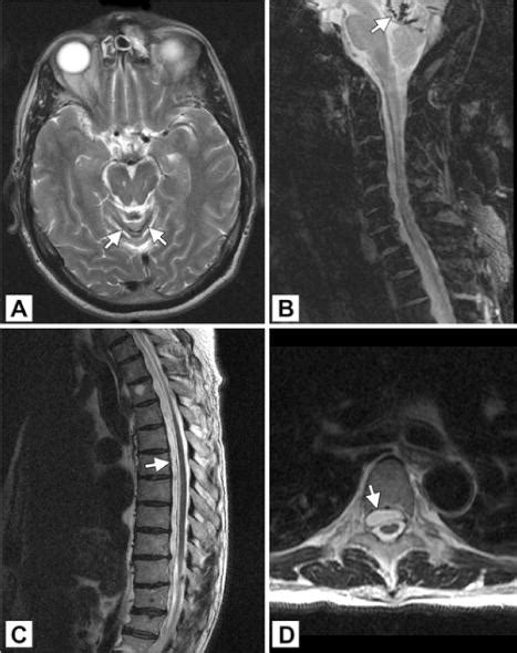 Chronic Cerebellar Hemorrhage In Spontaneous Intracranial Hypotension