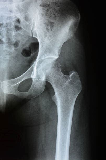 2,700+ Hip Arthritis X Ray Stock Photos, Pictures & Royalty-Free Images ...