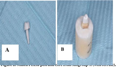 Figure 2 from Ferrule Effect on Fracture Resistance of Endodontically Treated Teeth Restored ...