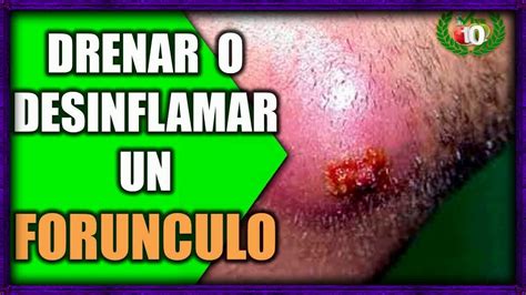 How Do You Get Rid Of A Boil 🎻 Boil Skin Disease - YouTube