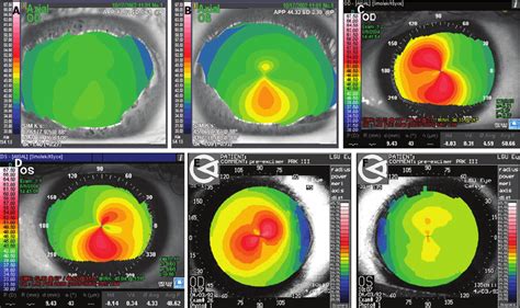 Examples Of Keratoconus A Forme Fruste Keratoconus Fellow Eye B