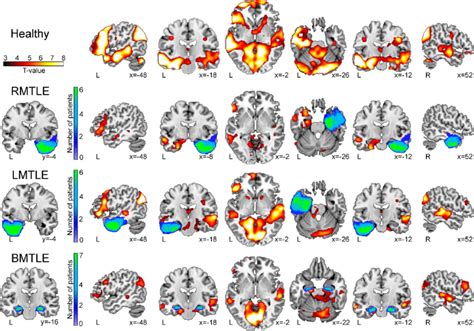 Enhanced Group Level Fmri Signals For The Autobiographical Memory Task