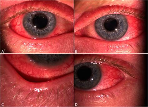 Slitlamp Photographs Of Dupilumabassociated Conjunctivitis In A