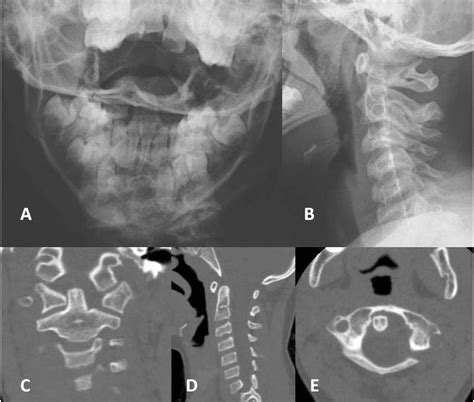 Atlantoaxial rotatory subluxation in children: A review