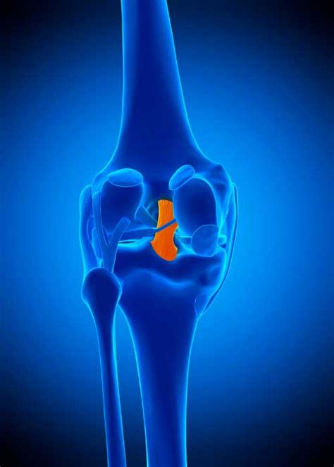 Posterior Cruciate Ligament (PCL) Reconstruction | Repair | Orthopedic Knee Surgeon | Manhattan ...