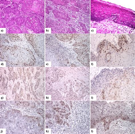 Oral Squamous Cell Carcinoma Tumor Invasion Front And Dysplastic