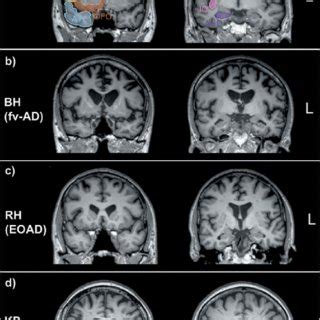 A Age And Sex Matched Control Brain MRI Sections Depicting Regions Of