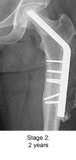 Femoral neck stress fracture - Biocomposites