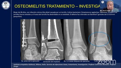 ActualizaciÓn En El Manejo De Osteomielitis Youtube