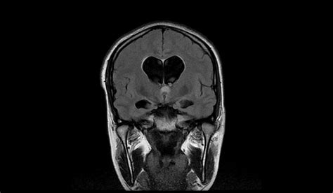 Colloid Cyst Mri Radiology Article On Colloid Cyst Of The Foramen Of Monro