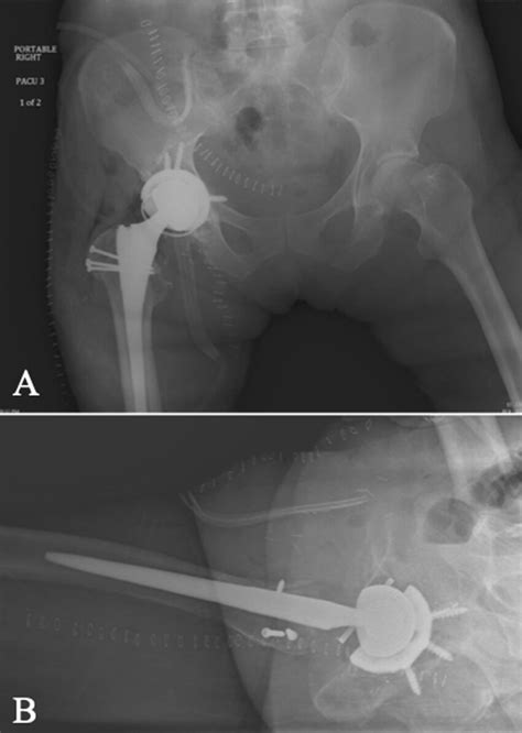 Immediate Anteroposterior A And Lateral B Postoperative Radiographs Download Scientific