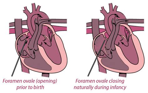 Foramen Ovale