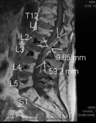 Lumbar Epidural Hematoma After Neuraxial Pain Procedure In A Patient