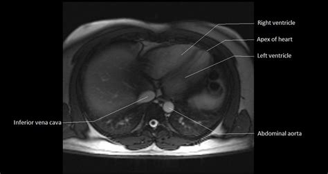 Mri Anatomy Of Heart Free Mri Axial Heart Cross Sectional Anatomy