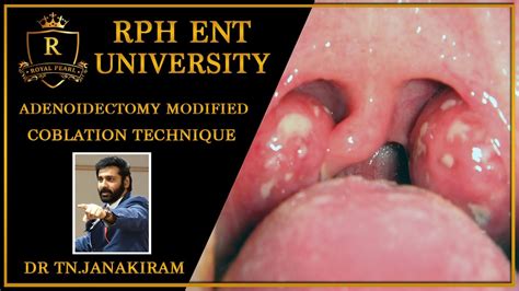 Adenoidectomy Modified Coblation Technique Of Janakiram For