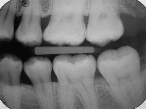 Tooth Bitewing Xray With Healthy Dentition Stock Photo - Download Image Now - Dental Health ...