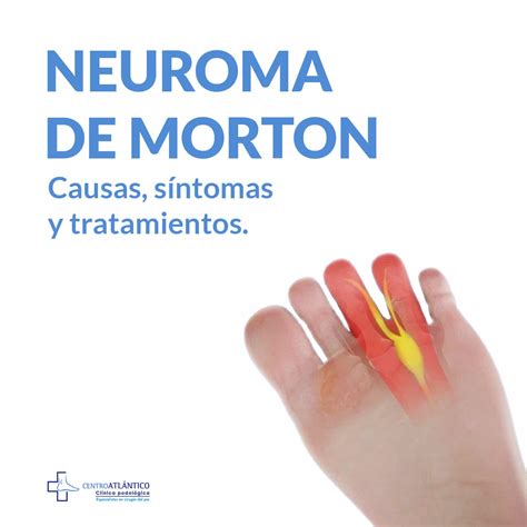 Neuroma De Morton Causas S Ntomas Y Tratamientos Centro Atl Ntico