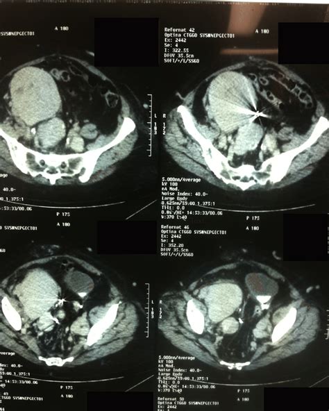 Abdominal And Pelvic Ct Scans Which Revealed Presence Of Several Download Scientific Diagram