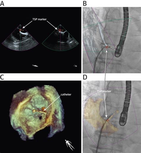 Echocardiography Fluoroscopy Fusion Imaging For Guidance Of Congenital