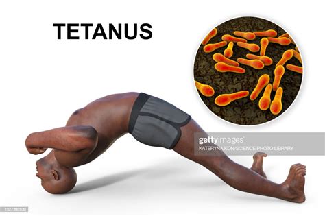 Tetanus Illustration High-Res Vector Graphic - Getty Images