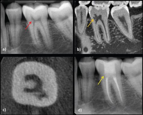 Root Resorption | Pocket Dentistry