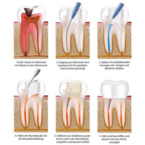 Endodontie Endodontologie Spezialist Zahnarzt In Oberviechtach