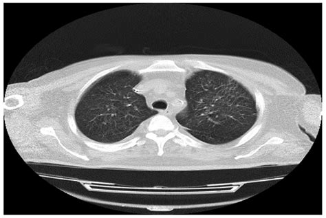 High Resolution Computed Tomography Hrct Scan Repeated After