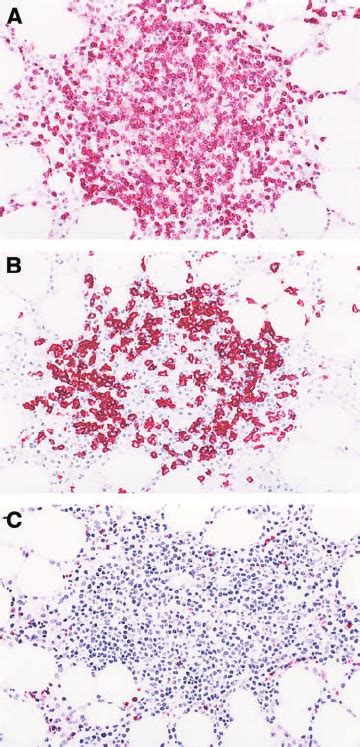 Aggregate Of Nonneoplastic Lymphocytes In A Bone Marrow Specimen