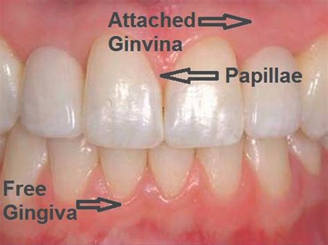 Gingiva By Ruth Thompson